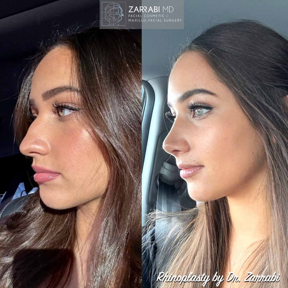 Ultrasonic Piezo Rhinoplasty 2 1