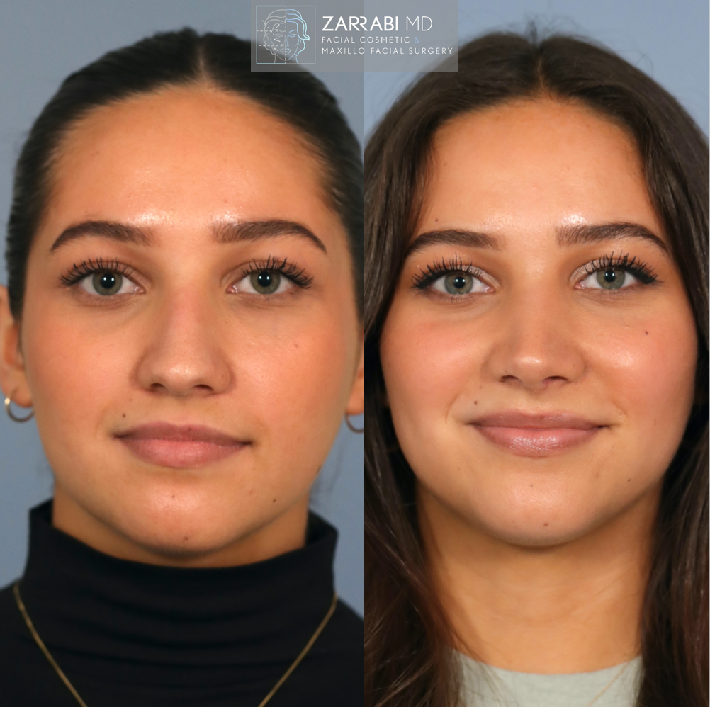 Ultrasonic Piezo Rhinoplasty 2