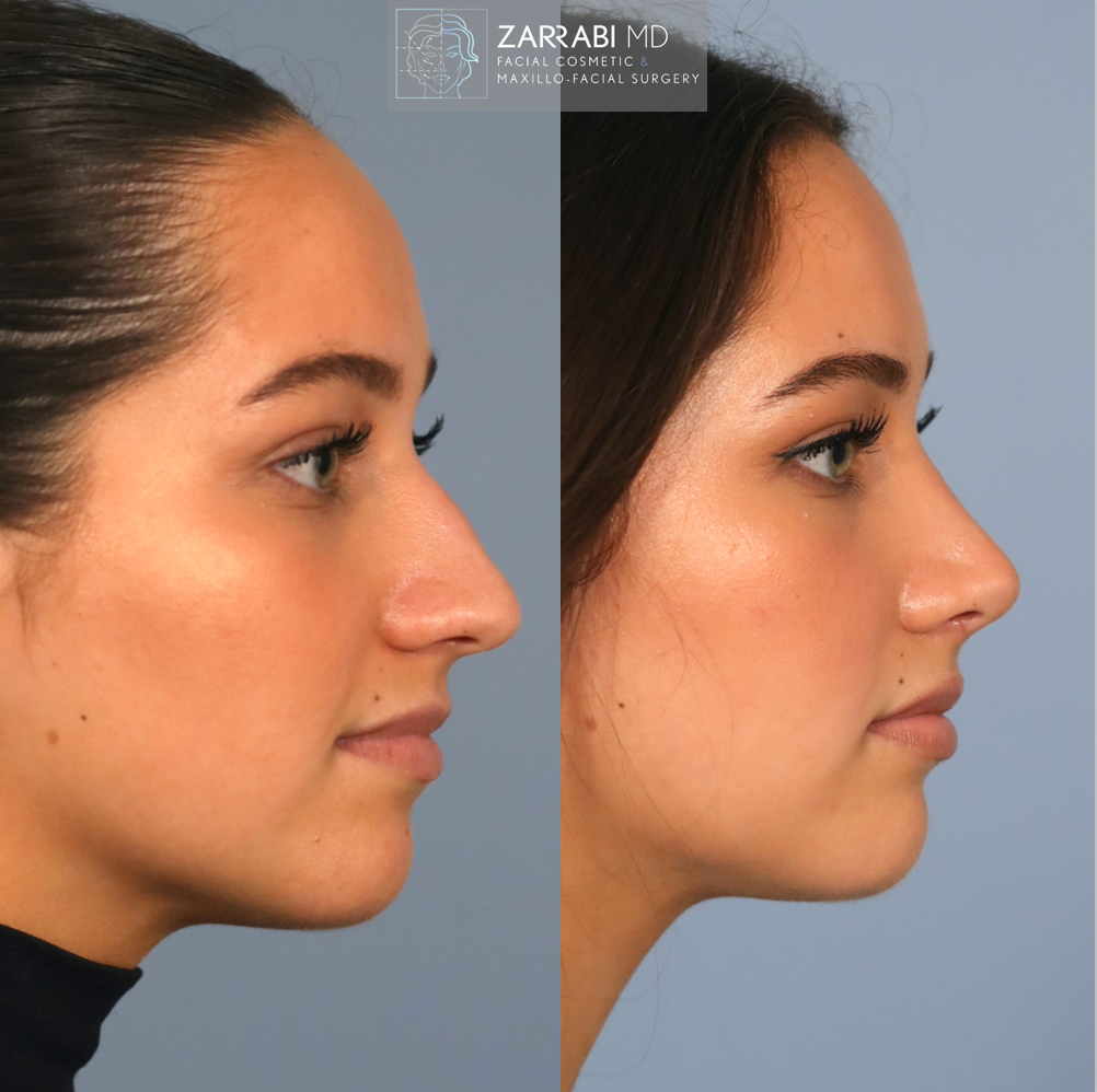 Ultrasonic Piezo Rhinoplasty 3