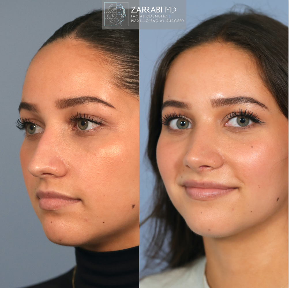 Ultrasonic Piezo Rhinoplasty 4