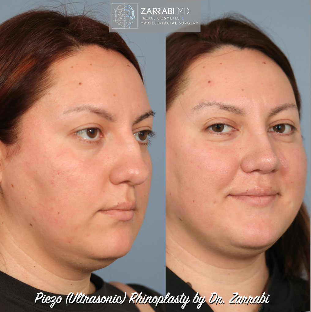 Ultrasonic Piezo Rhinoplasty 5 2