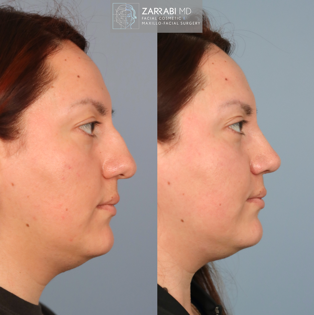 Ultrasonic Piezo Rhinoplasty 5 3