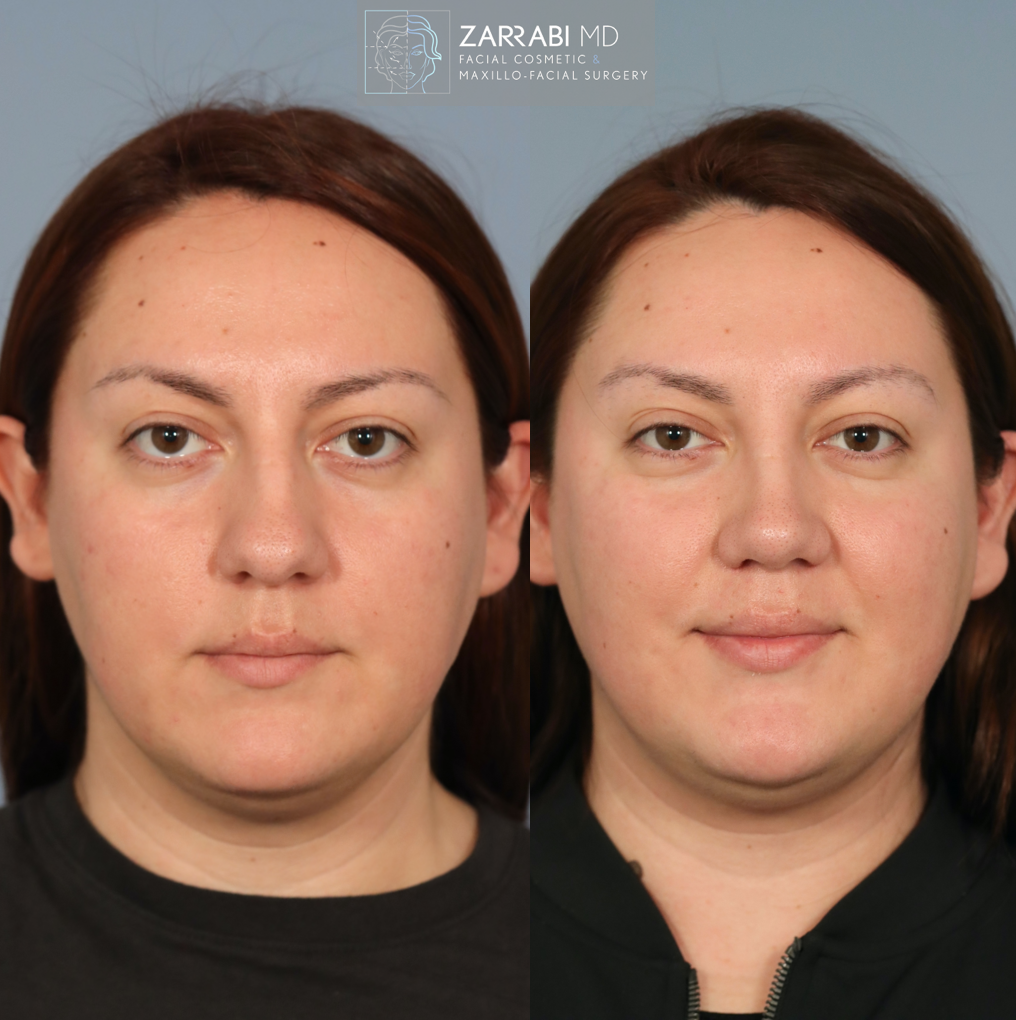 Ultrasonic Piezo Rhinoplasty 5 4