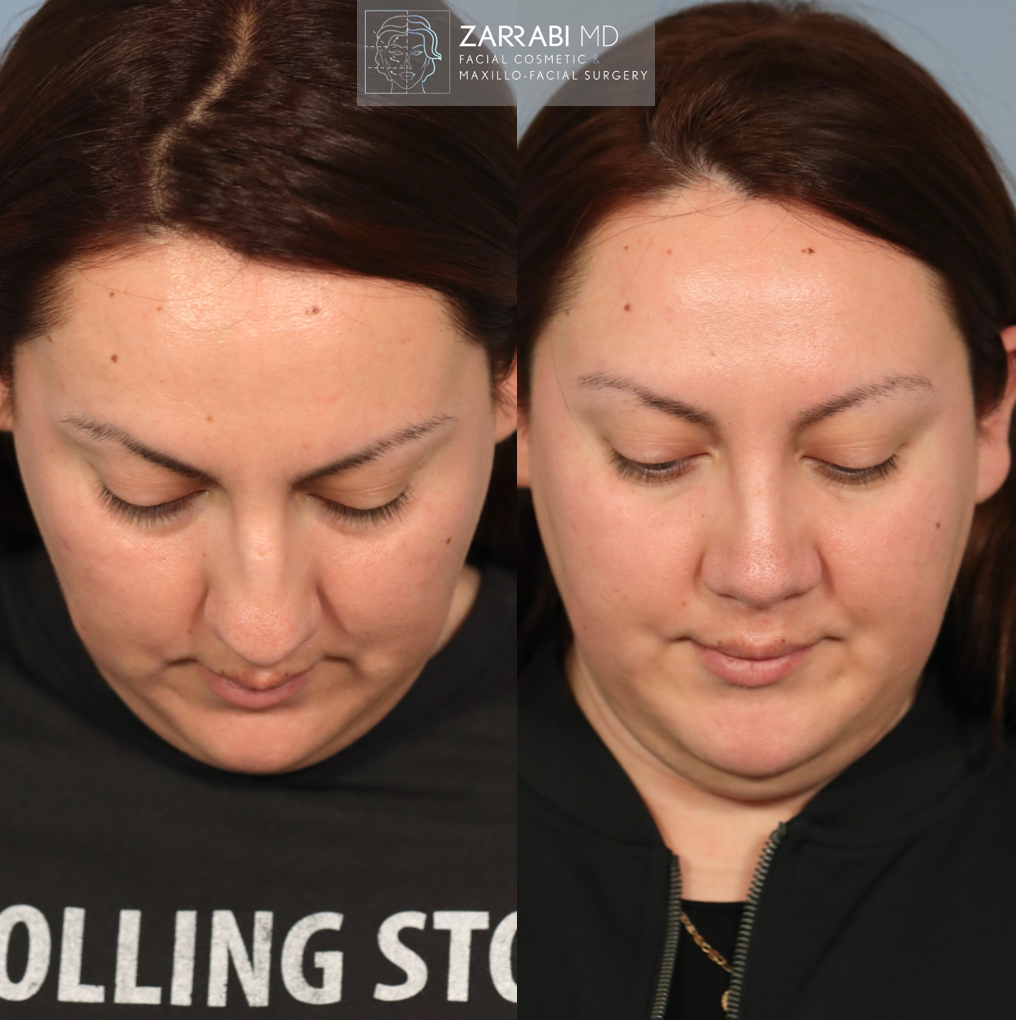 Ultrasonic Piezo Rhinoplasty 5 6