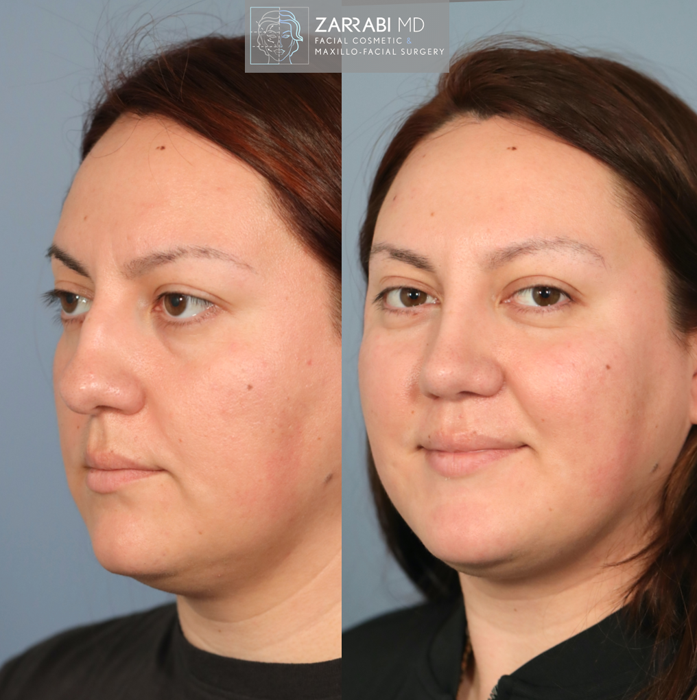 Ultrasonic Piezo Rhinoplasty 5 7