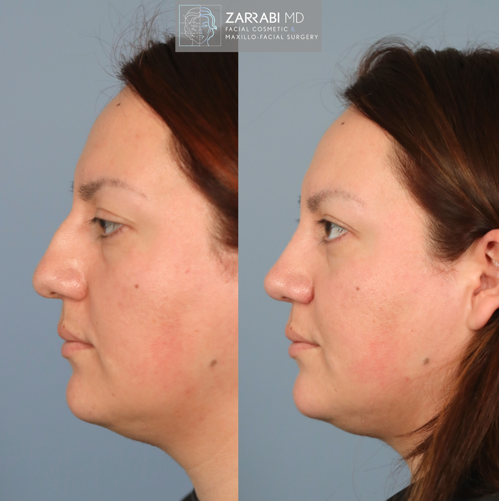 Ultrasonic Piezo Rhinoplasty 5 8