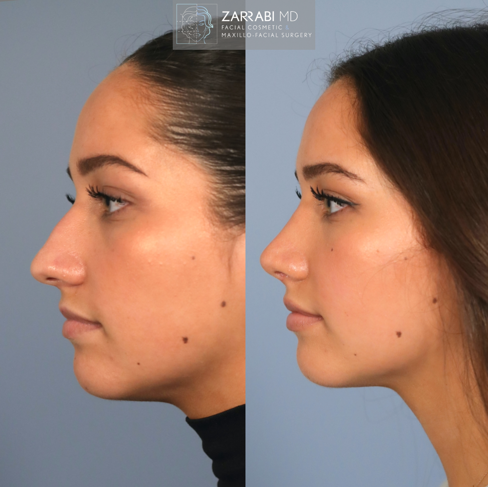 Ultrasonic Piezo Rhinoplasty 5