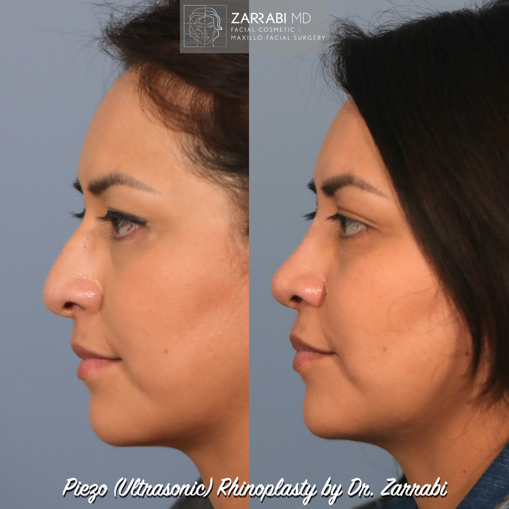 Ultrasonic Rhinoplasty 1 1