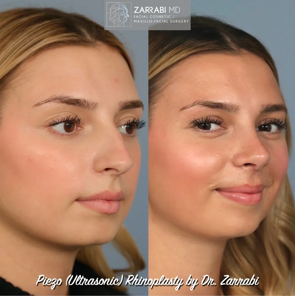 Ultrasonic Rhinoplasty 1