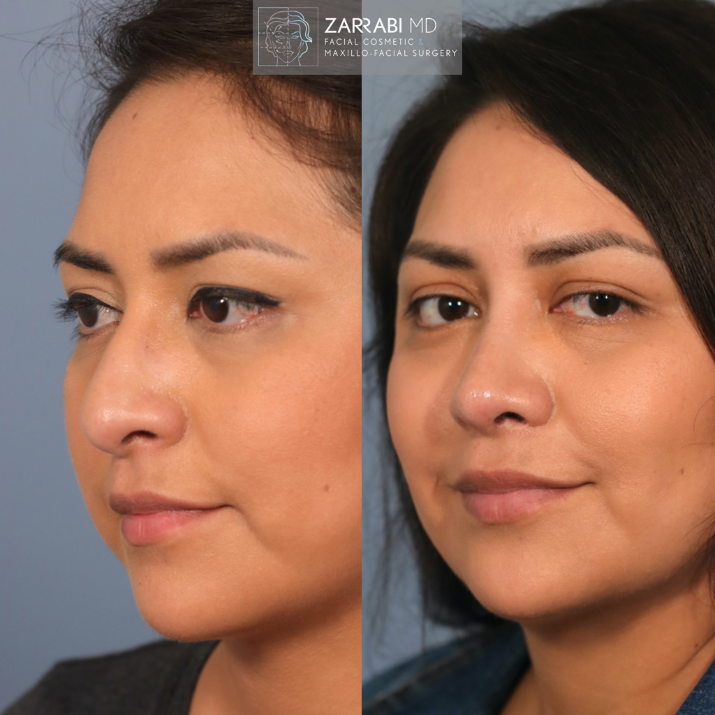 Ultrasonic Rhinoplasty 2 1