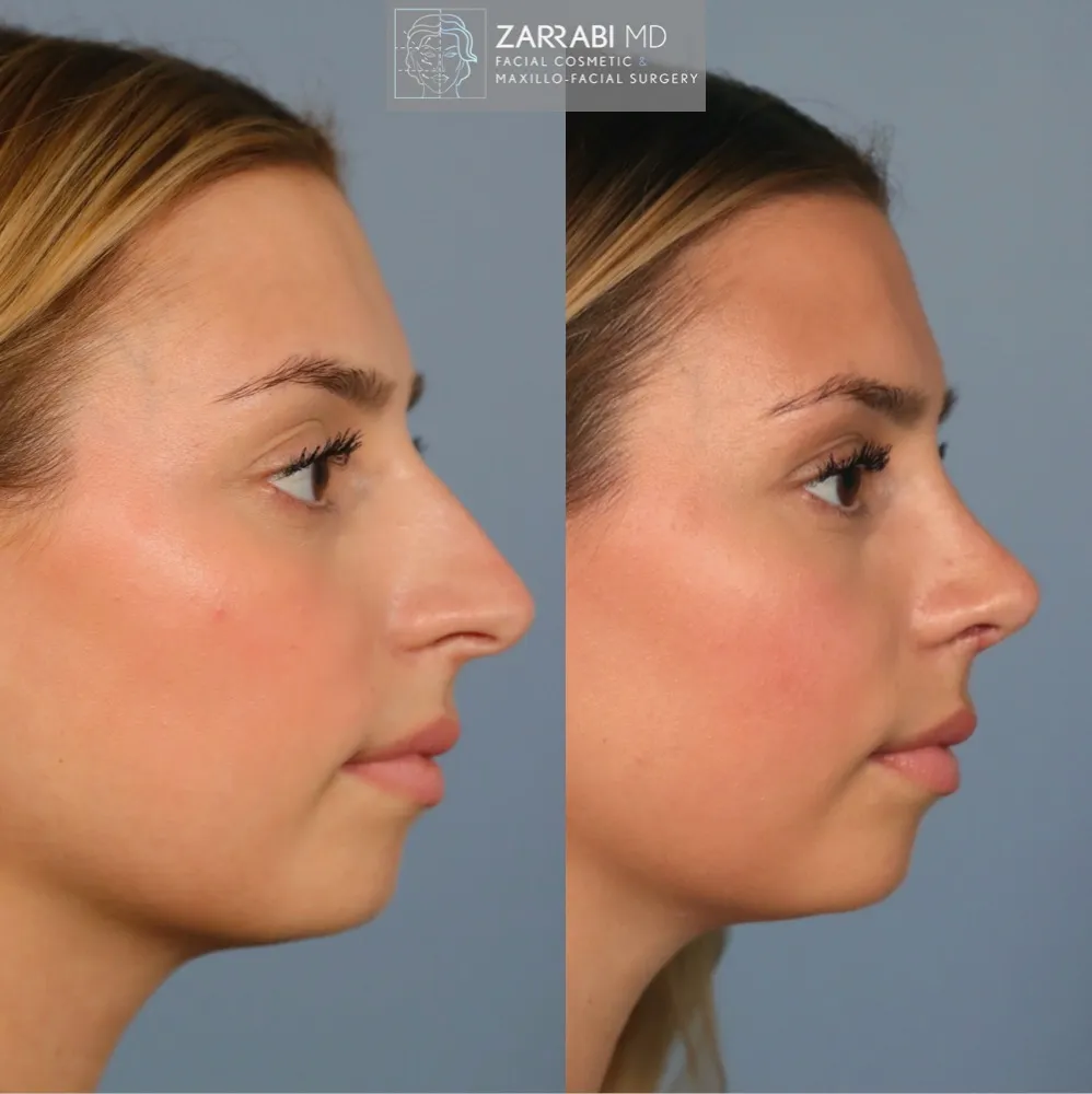 Ultrasonic Rhinoplasty 2