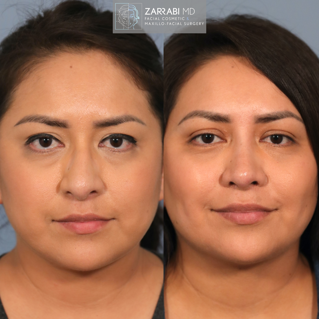Ultrasonic Rhinoplasty 3 1