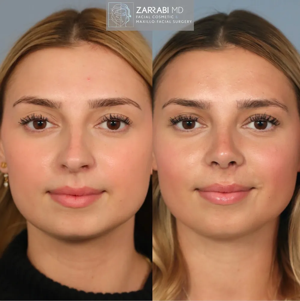 Ultrasonic Rhinoplasty 3