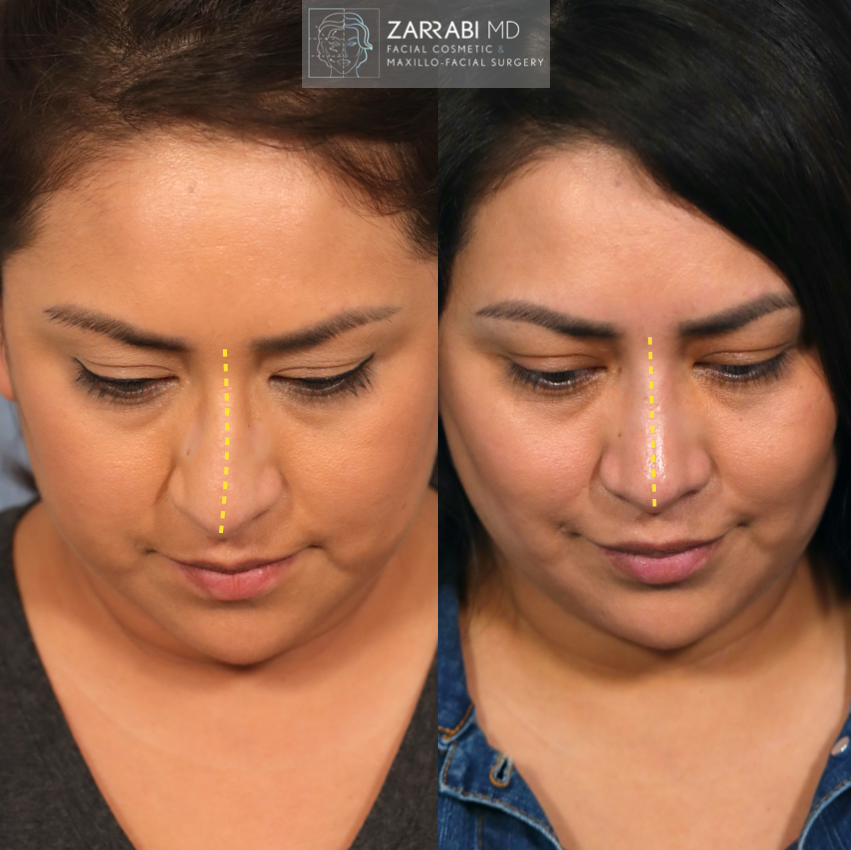 Ultrasonic Rhinoplasty 4 1