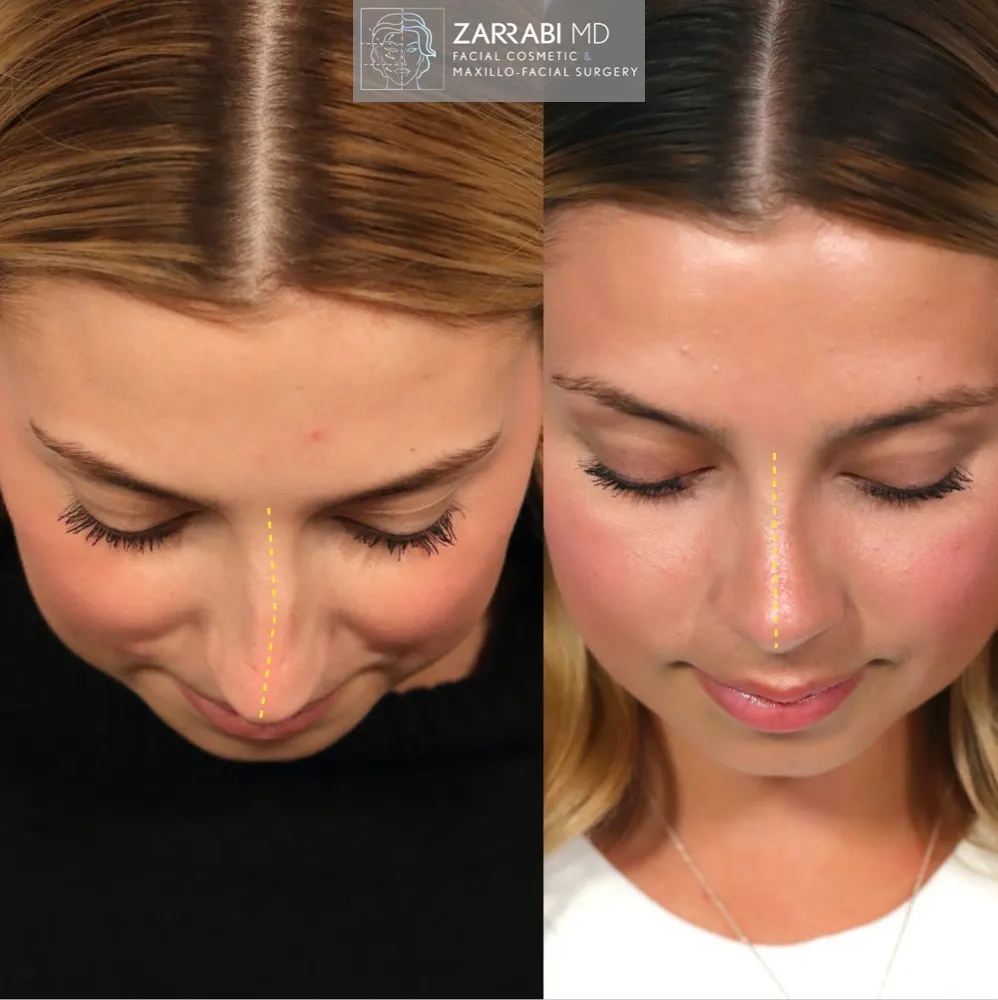 Ultrasonic Rhinoplasty 4