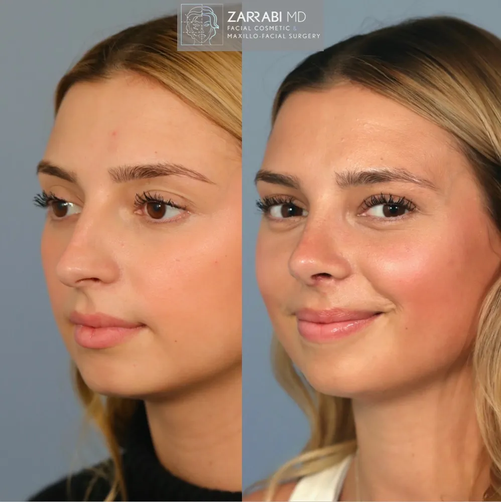 Ultrasonic Rhinoplasty 5