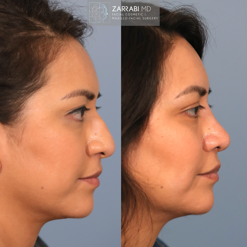 Ultrasonic Rhinoplasty 6 1