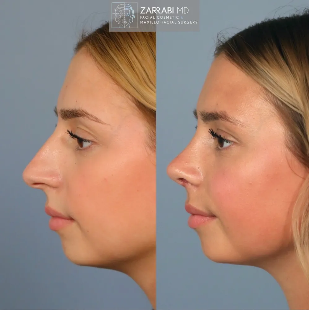 Ultrasonic Rhinoplasty 6