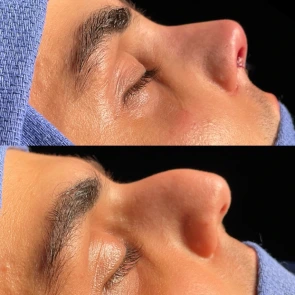closed piezo rhinoplasty case 1