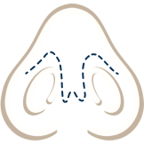 Techniques for repairing a Open nose banner