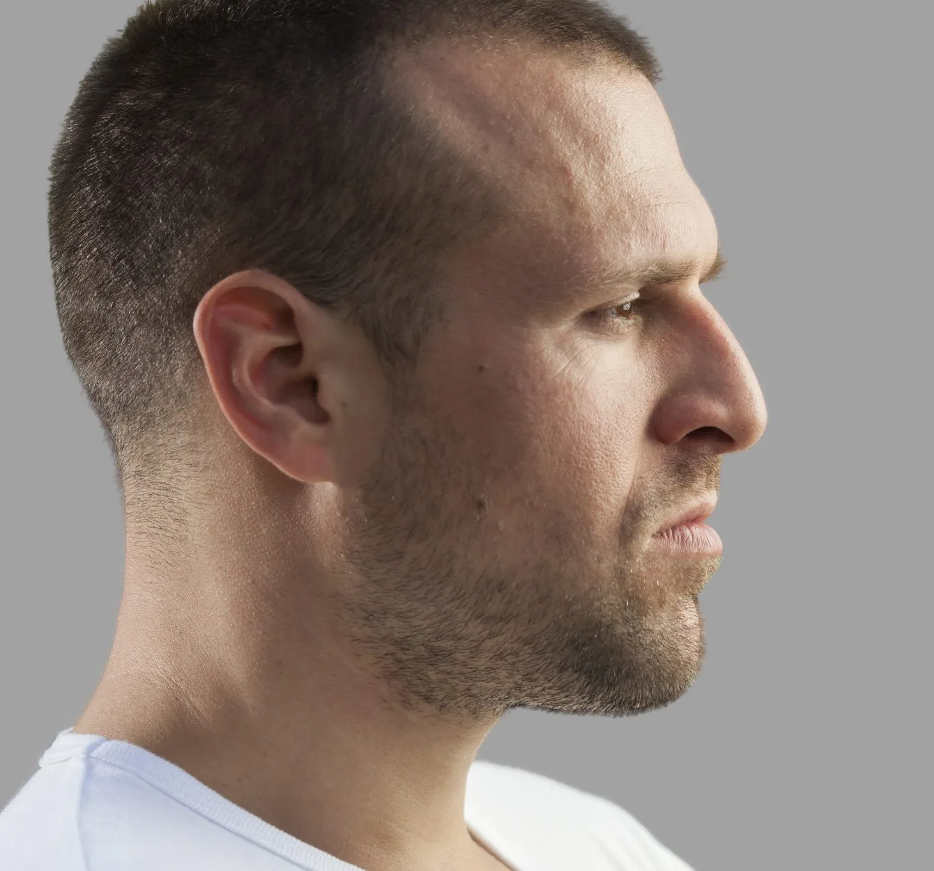 What is a Dorsal Hump Rhinoplasty? Banner