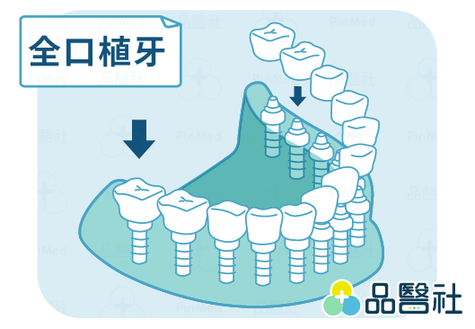 全口重建-全口植牙