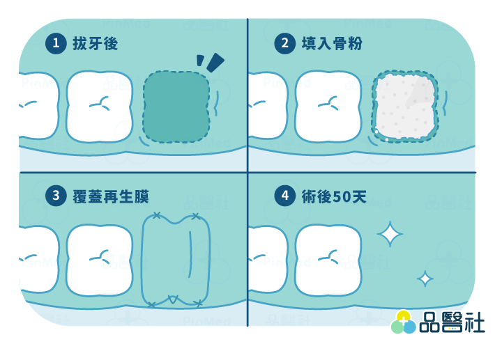 植牙補骨-骨脊保存數