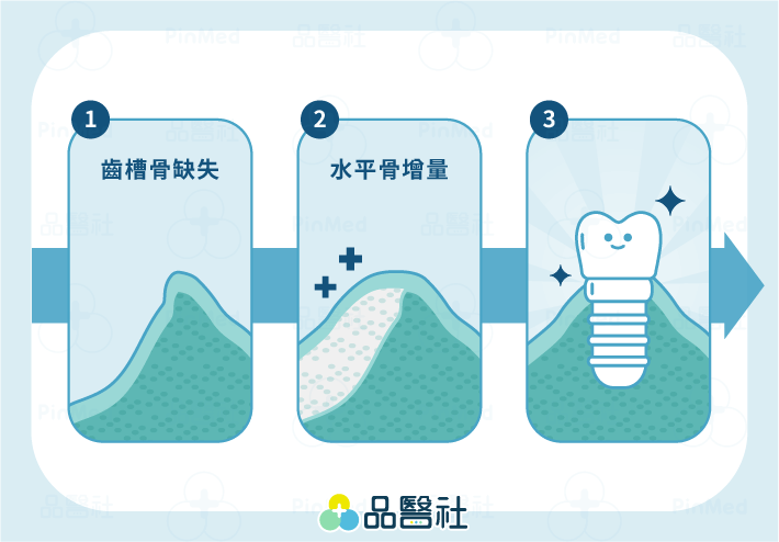 植牙補骨-水平骨增量