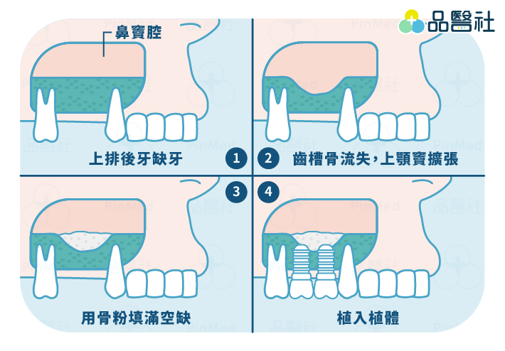 植牙補骨-鼻竇增高術