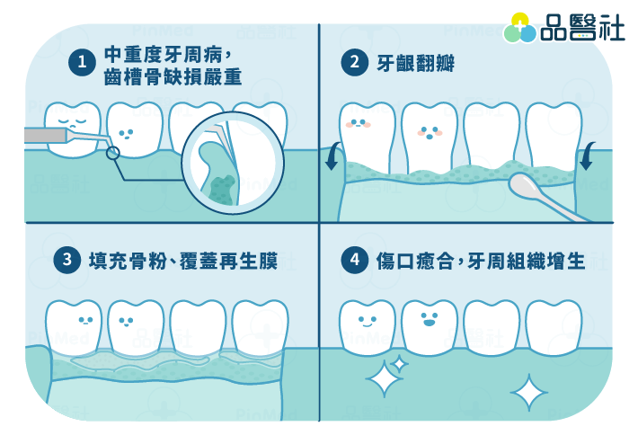 植牙補骨-牙周再生