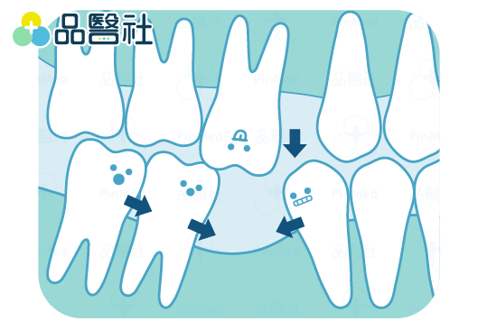 缺牙不補-導致牙齒歪斜