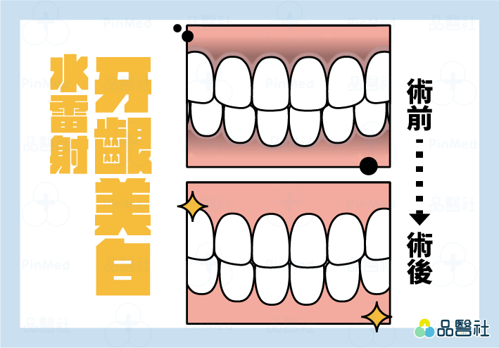 水雷射牙齦美白、牙冠增長術、牙齦整形手術