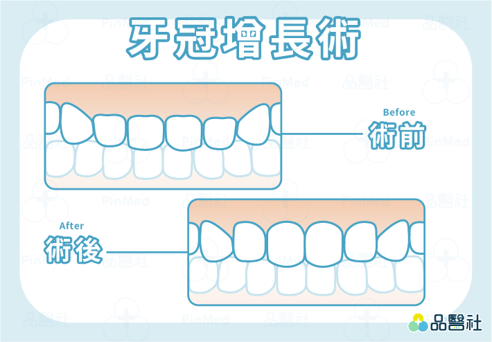 牙冠增長術術前術後比較圖