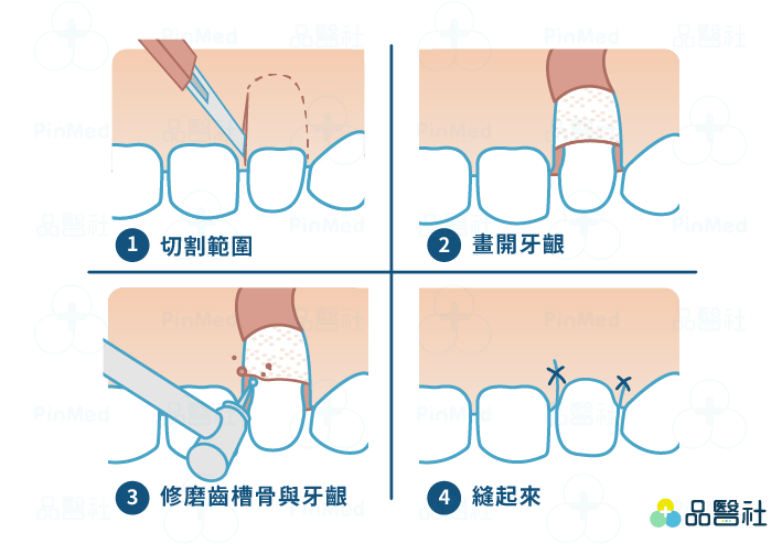 牙冠增長術手術過程