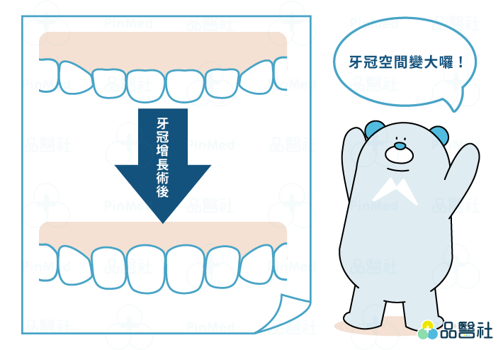 牙冠增長術牙齒太小