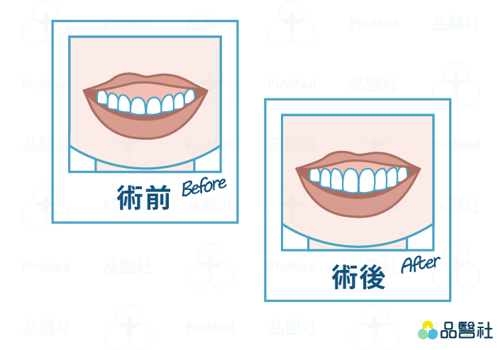 牙冠增長術–微笑露牙齦