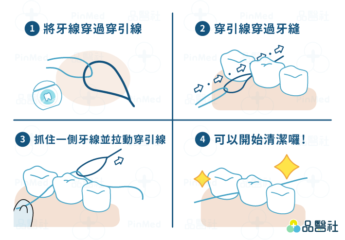 牙橋清潔可以透過牙橋穿引線來協助將牙線穿過牙橋，做徹底清潔