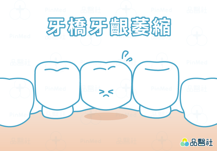 牙橋清潔不乾淨，時間久了會造成牙齦萎縮，牙橋縫隙變大，牙橋不密合