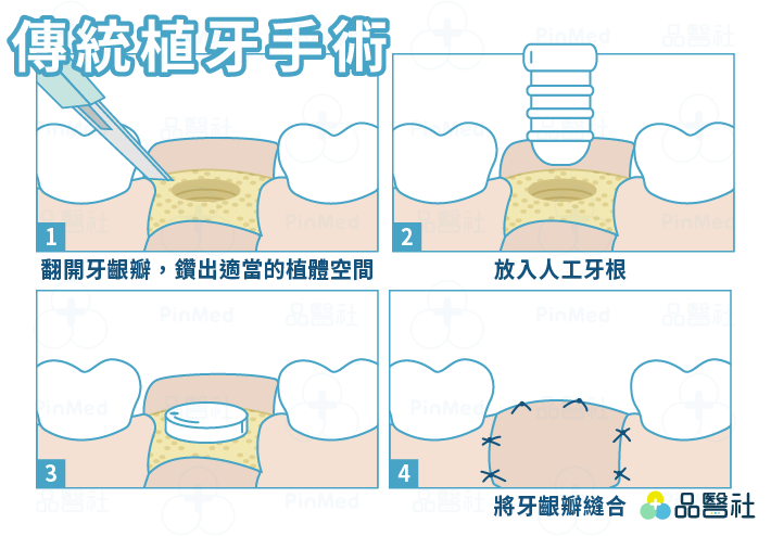 無痛植牙_傳統植牙手術過程圖