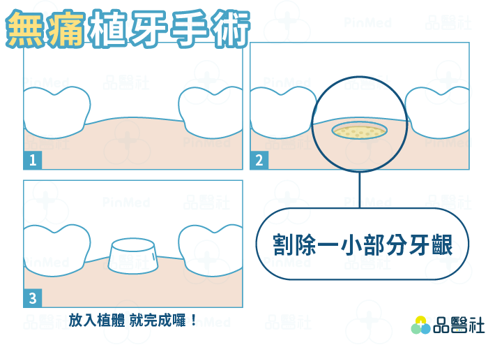 無痛植牙_無痛植牙手術過程圖