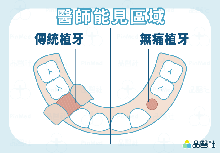 無痛植牙_傳統植牙與無痛植牙醫師能見區域