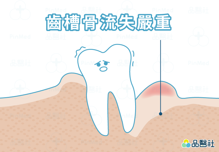 無痛植牙_骨質條件不佳