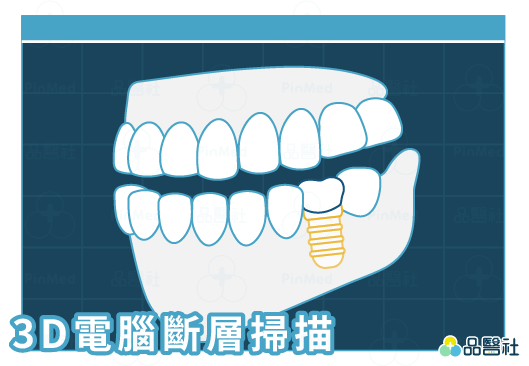 無痛植牙_3D電腦斷層掃描設備