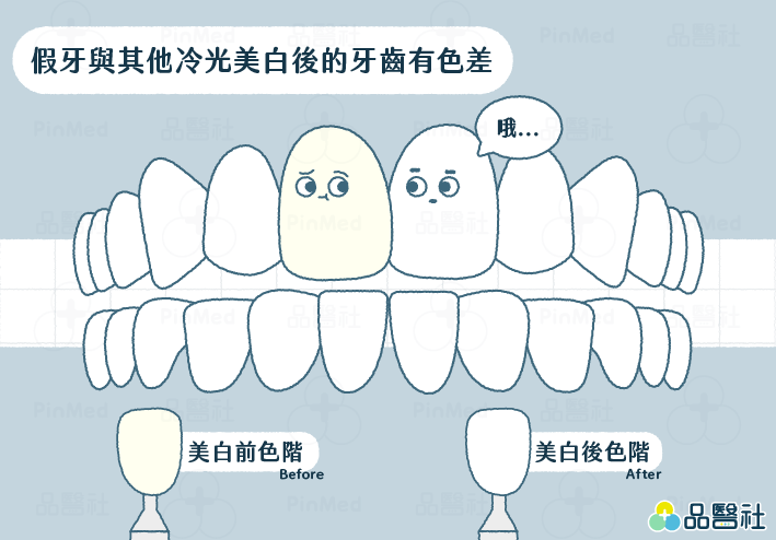 冷光美白_冷光美白與假牙顏色差