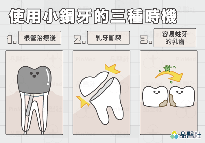 小鋼牙_裝上小鋼牙的3種時機