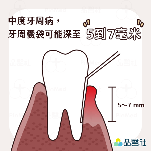 牙周病症狀_牙周囊袋