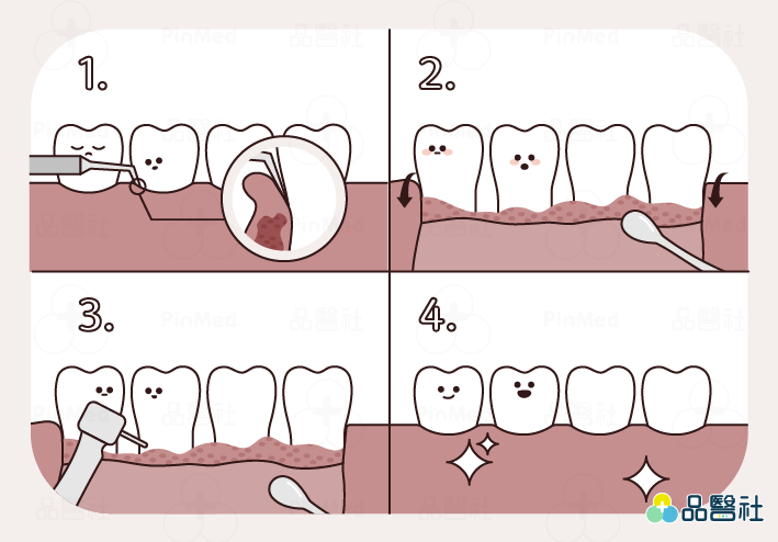 牙周病症狀_牙周翻瓣手術