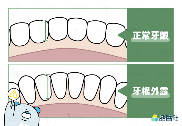 牙根外露_牙根外露與正常牙齦