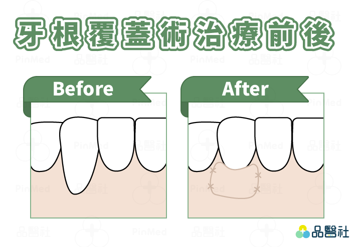 牙根外露_ˊ牙根覆蓋術