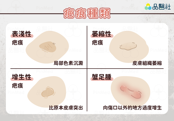 除疤-疤痕種類